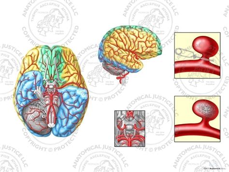 Right Internal Carotid Artery Aneurysm Illustration | Anatomical Justice