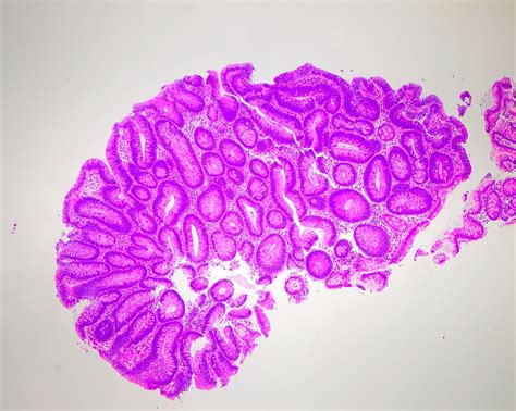 Tubular Adenoma Histology