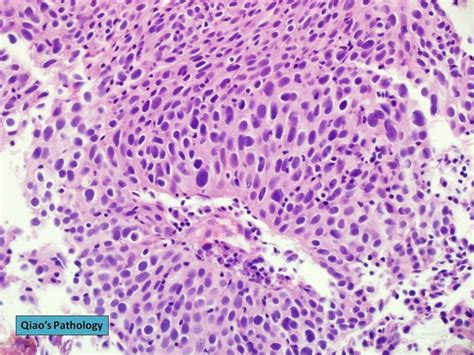 Flickriver Photoset Papillary Urothelial Carcinoma Of The Bladder By