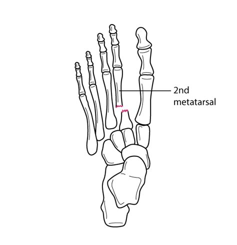 Metatarsal Fractures Injuries And Poisoning Merck Manuals Consumer