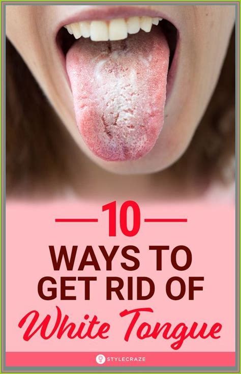 How To Get Rid Of A White Tongue | White tongue, Tongue health, Tongue