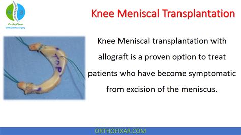 Knee Meniscal Transplantation • Easy Explained Orthofixar 2022 In