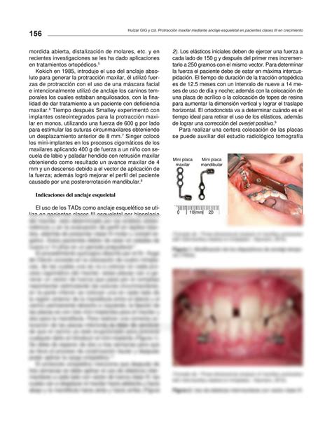 SOLUTION Protracci N Maxilar Mediante Anclaje Esqueletal En Pacientes