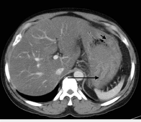 Computed Tomography Of The Abdomen With Contrast Showing Increased