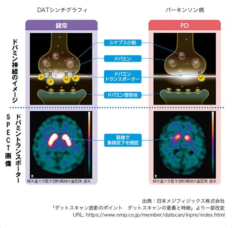 パーキンソン病の診断にmriは有用ですか？: パーキンソン症候群様症状の有無の検査 – ZCDC