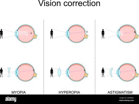 Vision Defects Myopia Hyperopia Astigmatism Vision Correction By Glasses Refractive Errors