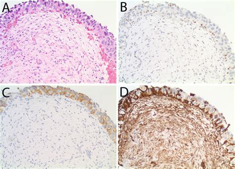 P Null Phenotype Is A Positive Result In Urothelial Carcinoma In