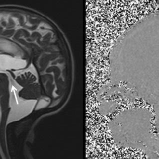 Typical images of communicating hydrocephalus in MRI. Left: Sagittal... | Download Scientific ...