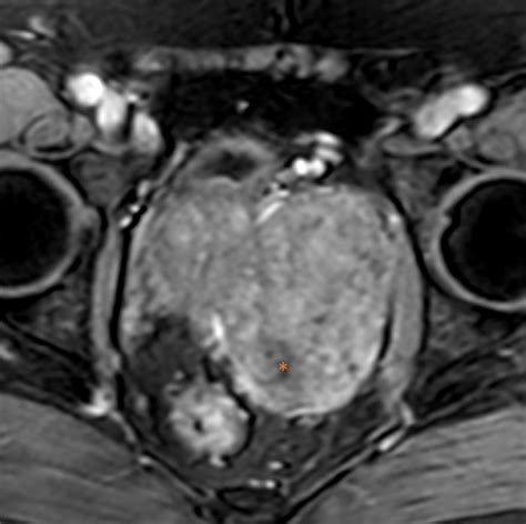 Prostatic Stromal Tumour Of Uncertain Malignant Potential Eurorad