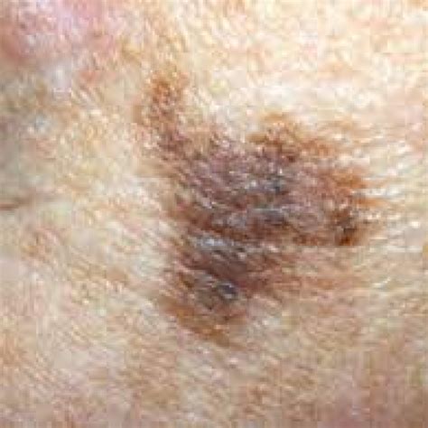 Types Of Melanoma - Melanoma Patients Australia