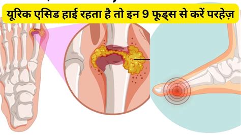 Consume 8 Foods Can Increase High Uric Acid In Joint Purine Diet Can