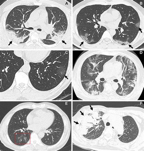 Current And Emerging Knowledge In Covid Radiology