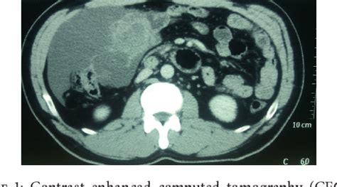 Figure 1 From Benign Multicystic Peritoneal Mesothelioma A Rare Tumour