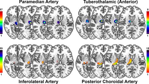 Three Dimensional Vascular Maps Of The Thalamus Stroke