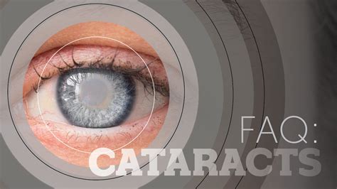 Cataract Treatment Our Most Frequently Asked Cataract Questions