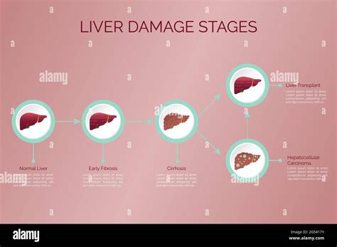Etapas Del Da O Hep Tico Enfermedad Del Higado Ilustraci N Del Vector