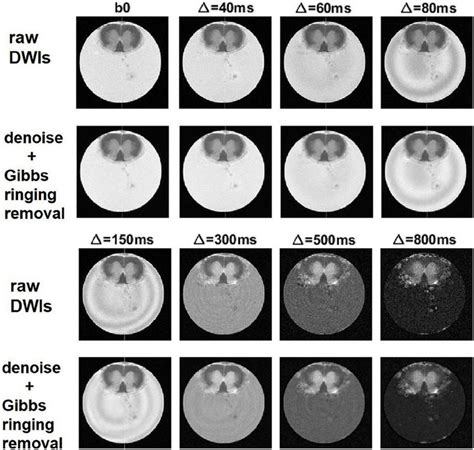 Denoising And Removal Of Gibbs Ringing Artifact In Dwi Used To Obtain