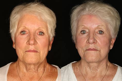 Vertical Deep Plane Facelift Before After Photos By Dr Ennis