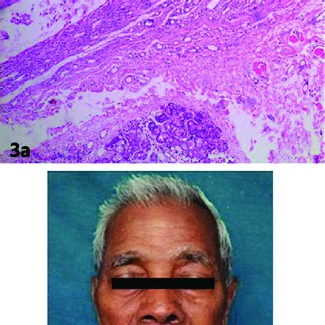 A Histopathology Of Plunging Ranula H And E Pseudocystic Cavity