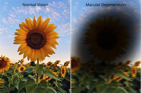 Macular Degeneration - 黃斑病變 - Inner West Eye Surgeons