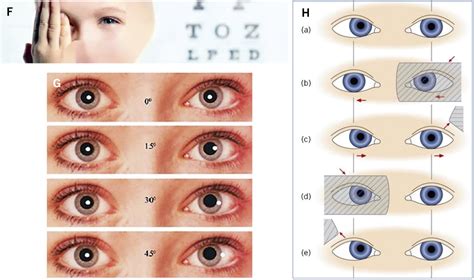 Oftalmología Pediatría integral