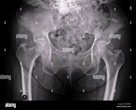 Normal Pelvic Radiograph Female Radiology Case Off