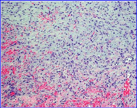 Haematoxylin And Eosin Hande Staining Of Resected Pseudoaneurysm Under