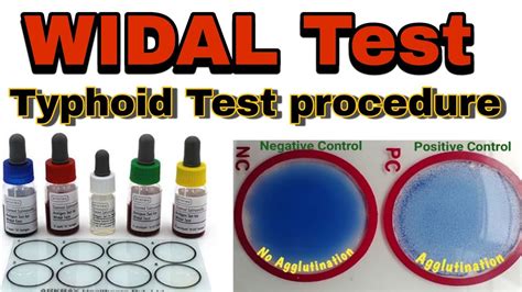 Immunology Widal Test Procedure Widal Test Kaise Kate Hai YouTube