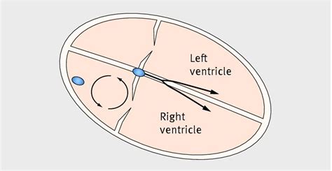 Mechanism For Atrial Flutter An Example Of A Macro Re Entrant Circuit