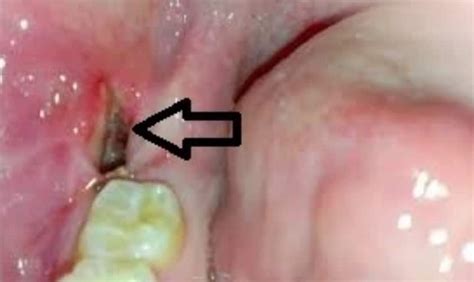 Dry Socket 5 Days After Wisdom Teeth Extraction