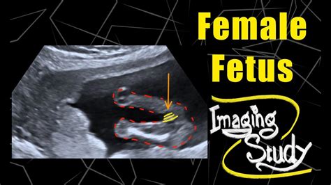 Female Fetus 16 Weeks Ultrasound Case 81 Youtube