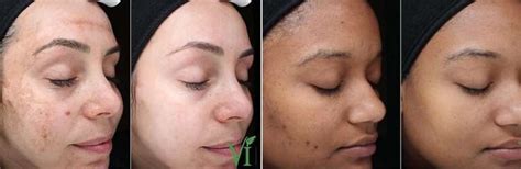 Vi Chemical Peel Brandon Dermatology