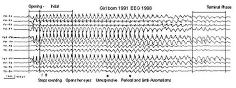 Eeg Seizure