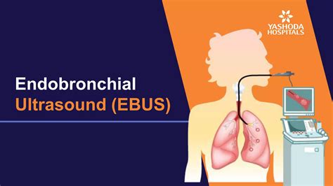 Endobronchial Ultrasound Bronchoscopy EBUS PPT