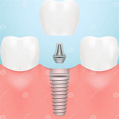 Tooth Human Implant Dental Concept Human Teeth Or Dentures Isolated On A Background Vector