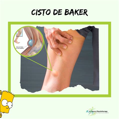 Cisto De Baker Tudo Que Voc Precisa Saber Enfermagem