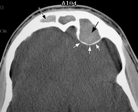 Imaging Features Of Invasive And Noninvasive Fungal Sinusitis A Review Radiographics