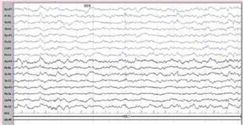 Normal Background Alpha Rhythm On The Eeg Download Scientific Diagram