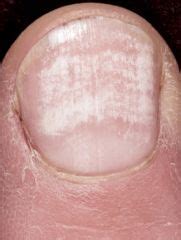 What Causes the White Spots on Your Toenails? | New Health Advisor