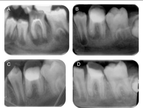 Figure 1 From Management Of Teeth With Persistent Apical Periodontitis After Root Canal