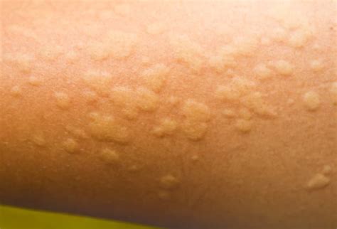 Hives Urticaria Pictures Types Causes And Treatment