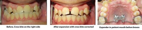 Crossbite Braces