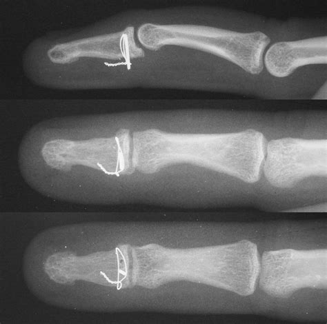 Trauma Open Reduction Distal Phalanx Base Fractures With Wires And Pins