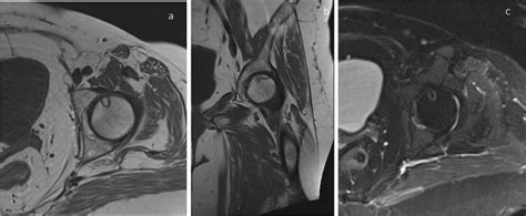 T1 Axial A And Coronal B And T2 Fat Saturated Axial C Images