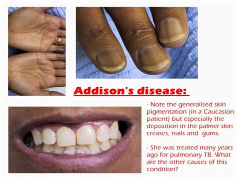 Medical Treatment Pictures For Better Understanding Addison’s Disease Diagnosis