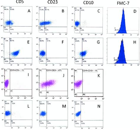 Patterns Of Immunophenotypic Aberrancies In Mantle Cell Lymphoma All