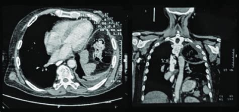 Contrast Enhanced Computed Tomography Chest Showing Areas Of