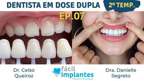 Preciso desgastar os meus dentes pra colocar lentes Fácil