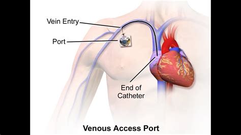 What is a catheter procedur - YouTube