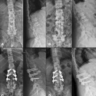 Postoperative Fluoroscopy A The Preoperative A P And Lateral